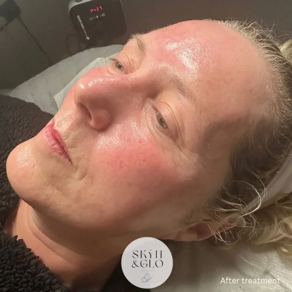 A woman's face after Dermalux LED light therapy treatment