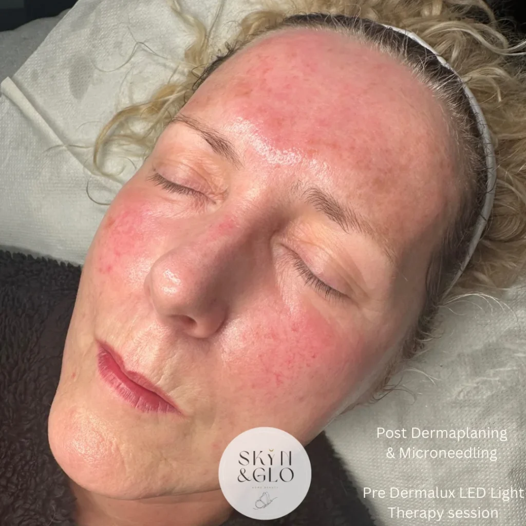 A woman's face before Dermalux LED light therapy treatment