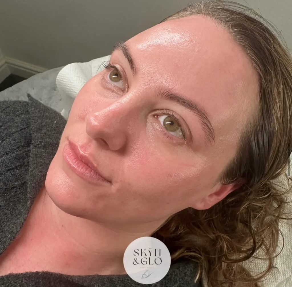 Before a classic dermaplane treatment