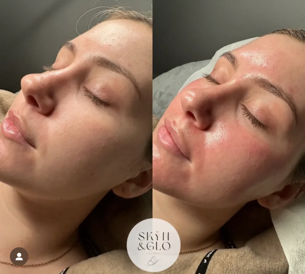 Before and after images of a woman's face following Deluxe Dermaplane treatment