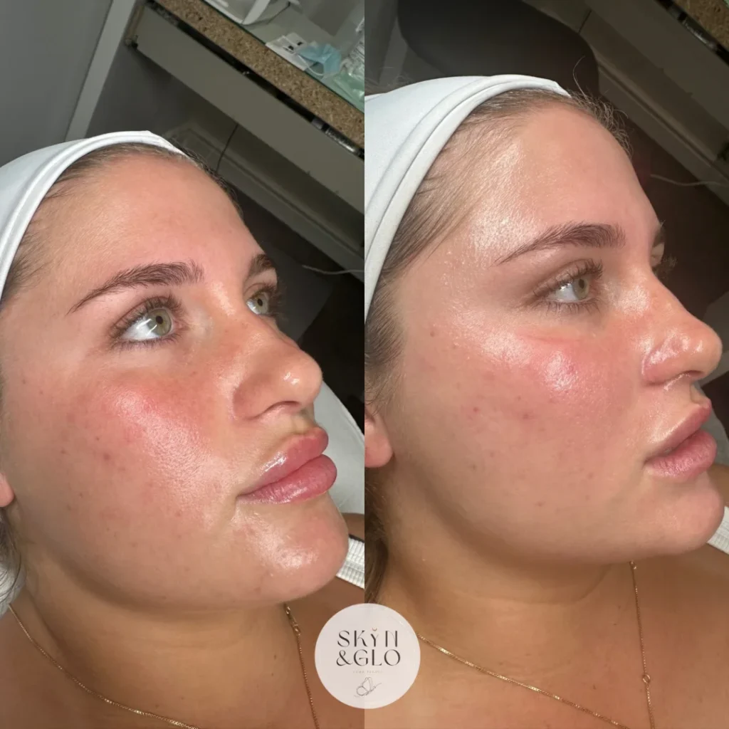 Before and after Dermaplane & Peel treatment