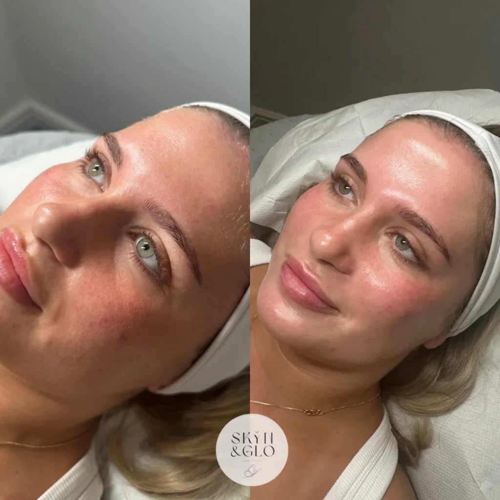 Before and after images of a Dermaplane and peel treatment
