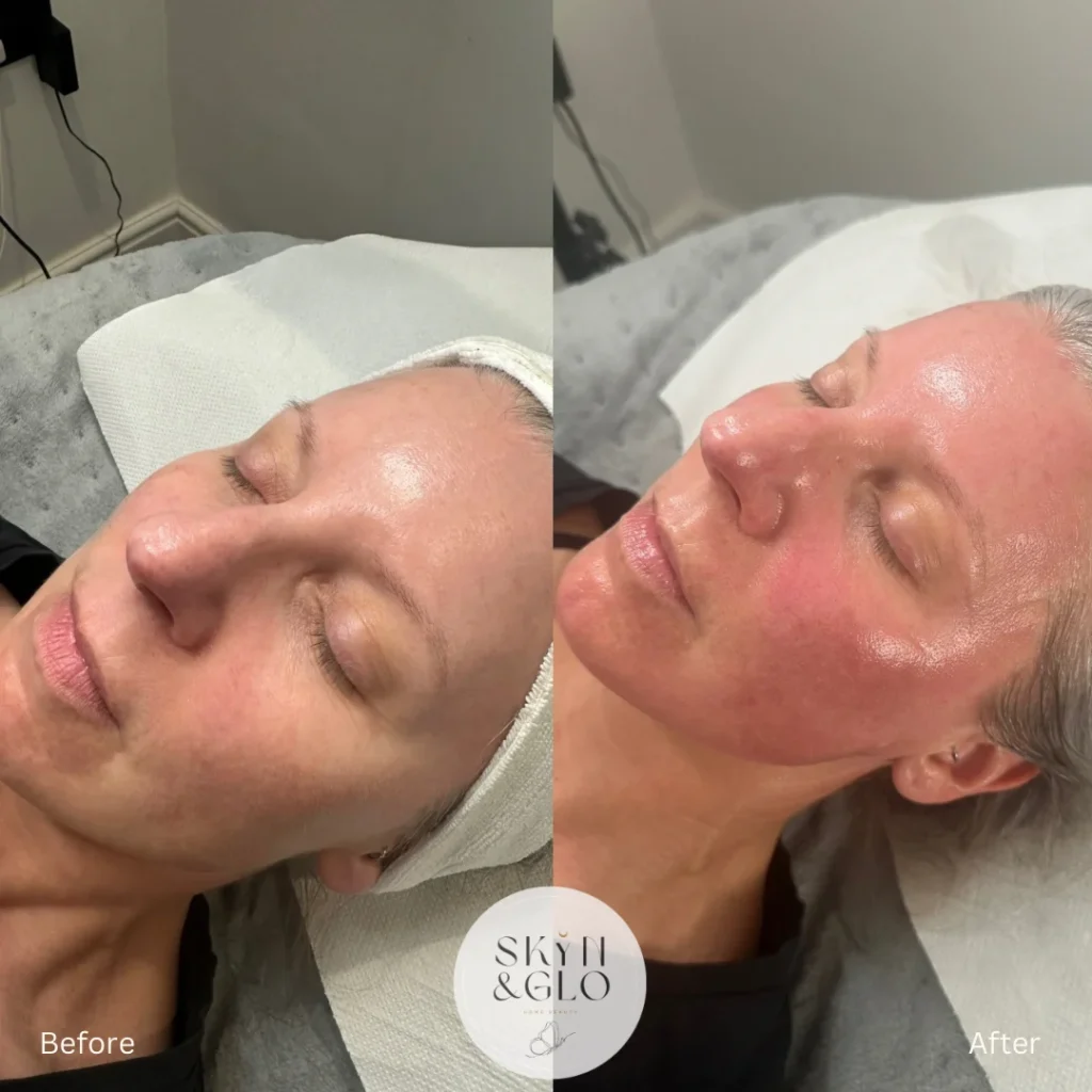 Before and after a Glo up facial