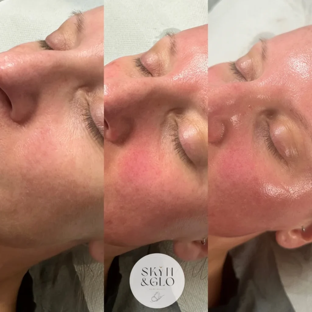 Before and after a Glo up facial