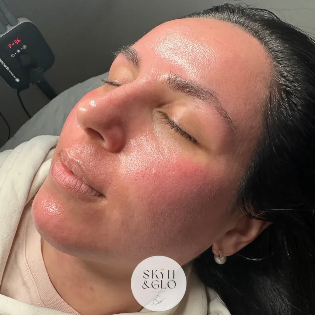 After a Lite Peel LED light therapy treatment