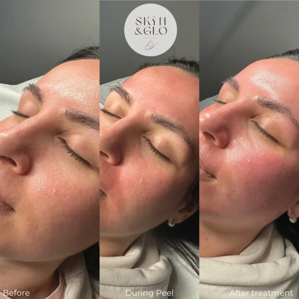 Before and after a Lite Peel LED light therapy treatment