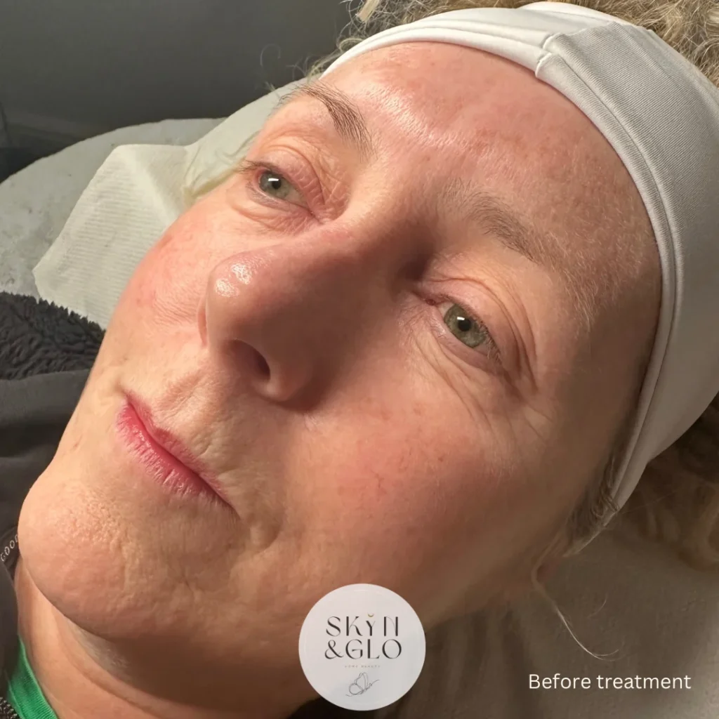 Before Micro-needling treatment