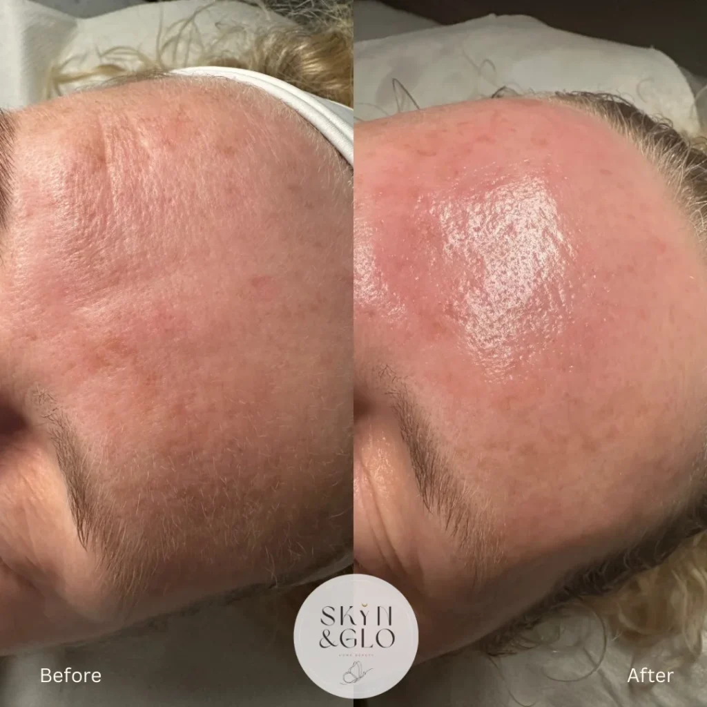 Before and after Micro-needling treatment